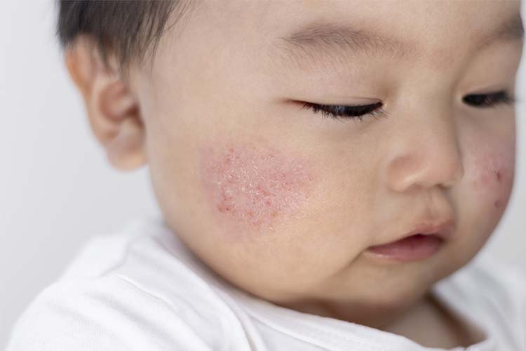こどもの肌トラブル