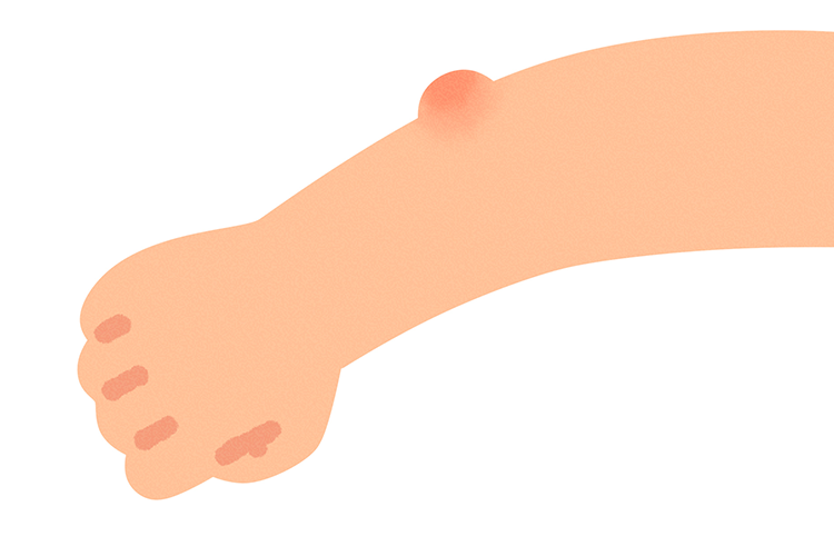 できもの・腫瘍